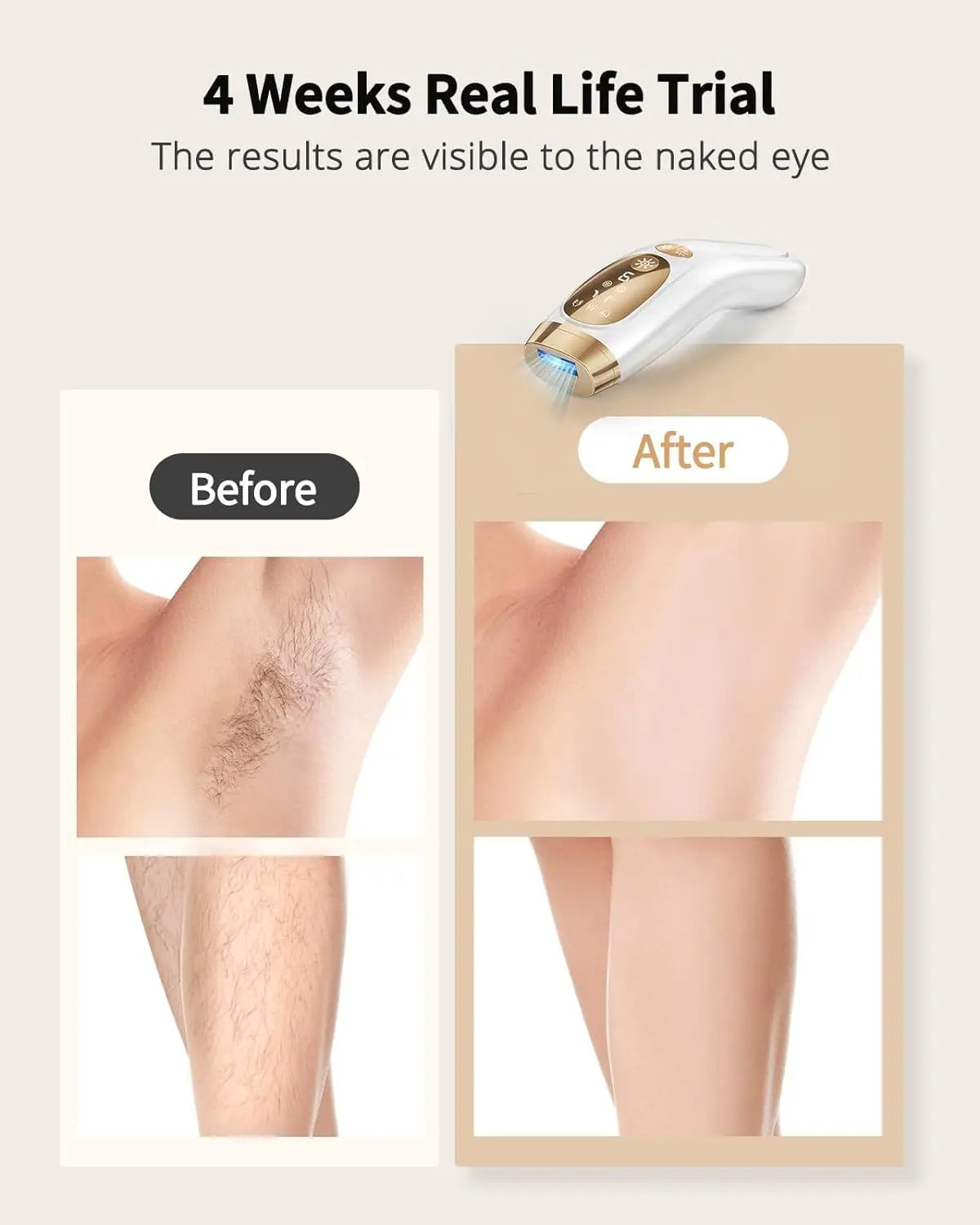 Permanent Laser Hair Removal at Home